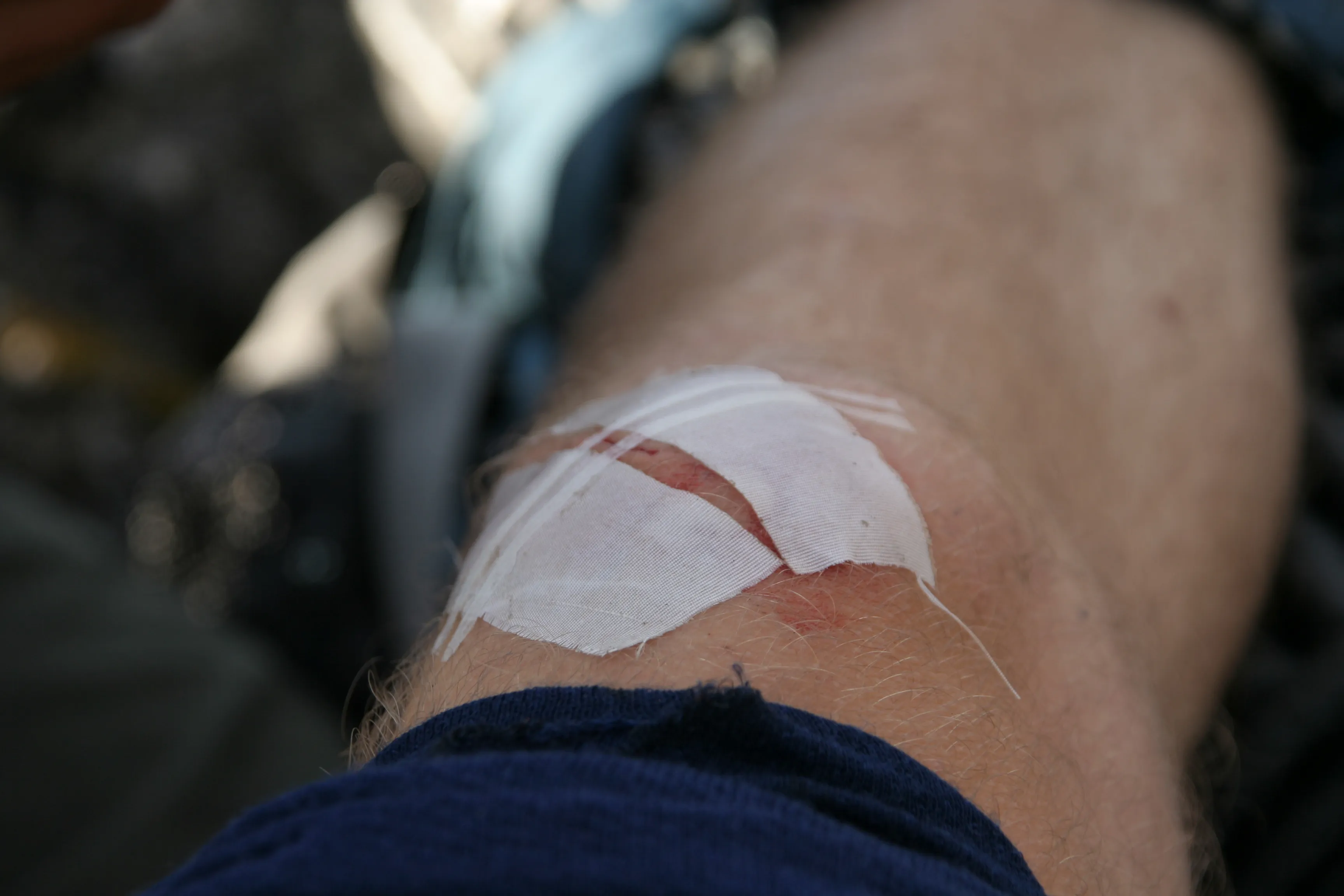Det holder med et par strips og et større plaster over. Her er det teipet over stripsen på begge sider av såret for å holde stripsen på plass.