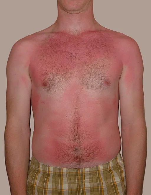 Superficial burns after a little too much sun and a little too little sunscreen.