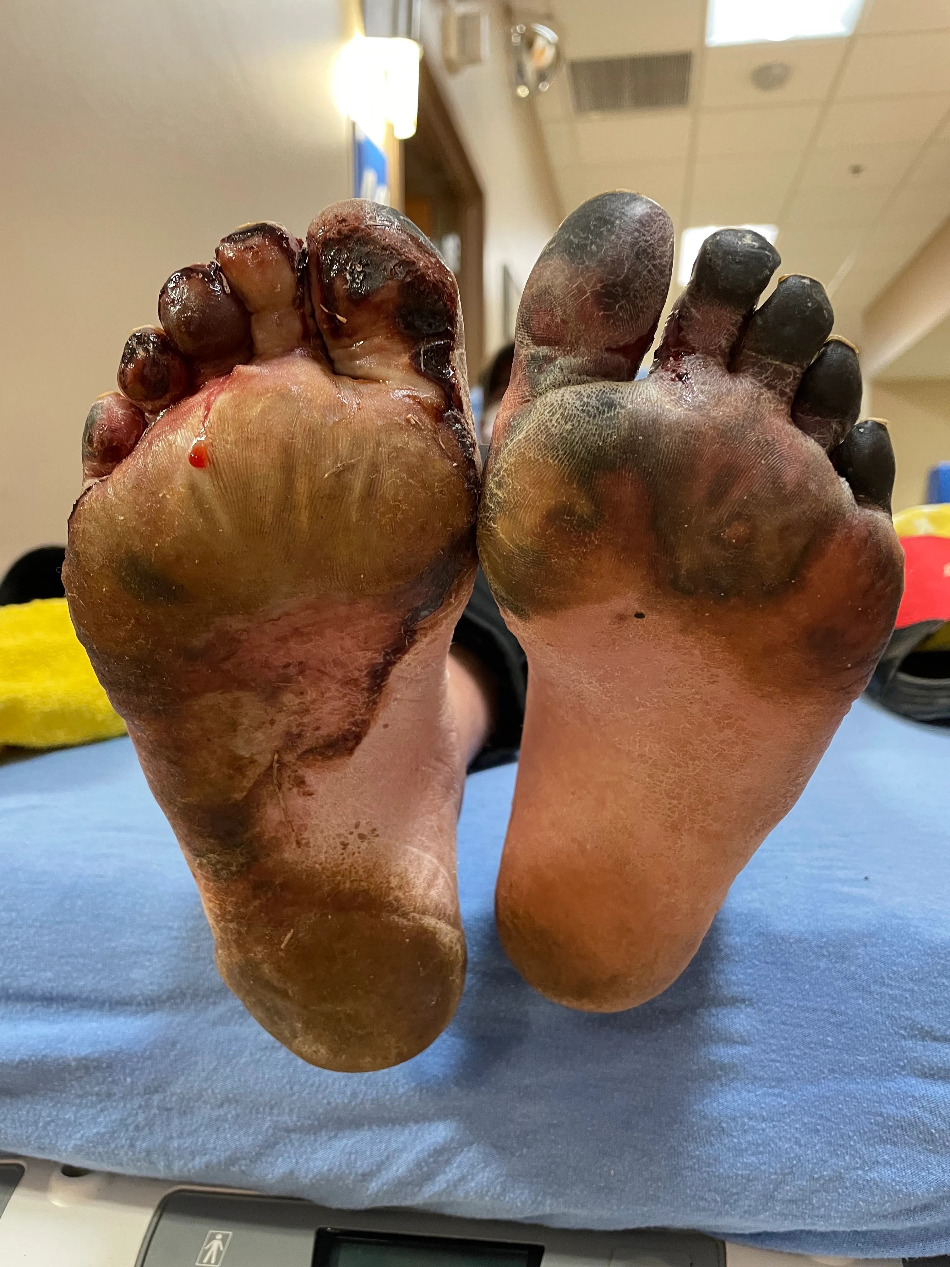 Deep frostbite on feet with blue-black discolouration.