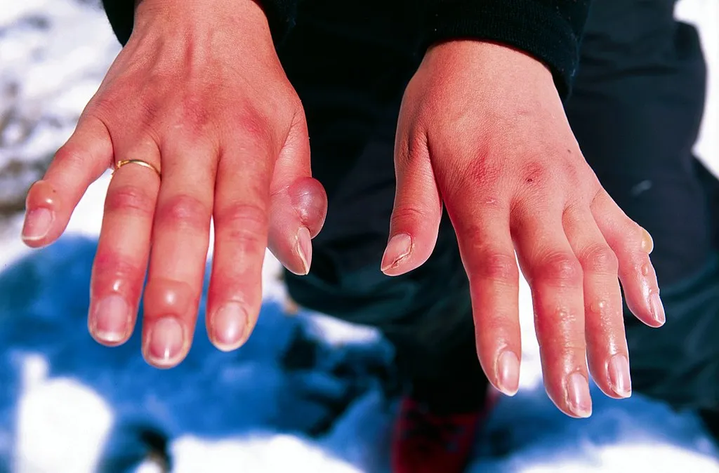 Superficial frostbite on hands with blisters.