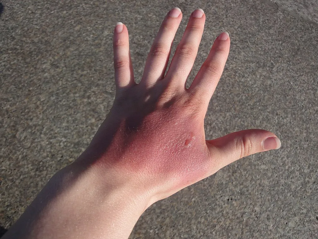 Hand after an encounter with boiling water, with blisters indicating second-degree burns.